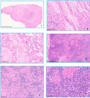 Indolent T-lymphoblastic proliferation with fibrolamellar hepatocellular carcinoma developed after colorectal adenocarcinoma: a case report